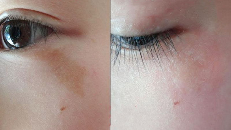 WilliamHill中文官方网站除疤